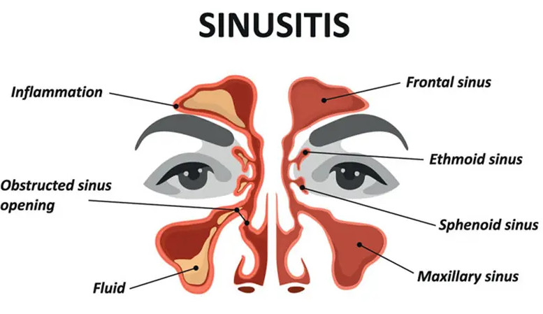 Best Homeopathic Remedies for Sinusitis
