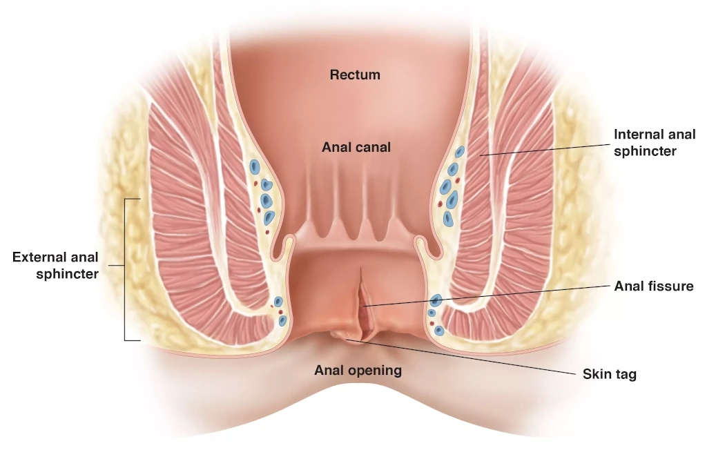 10 Best Homeopathic Medicines For Anal Fissure