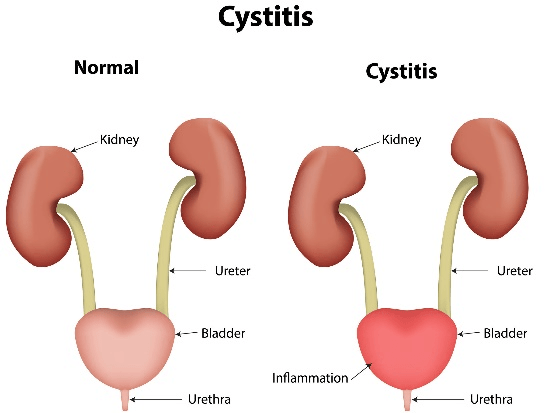 Best Homeopathic Medicines for Cystitis