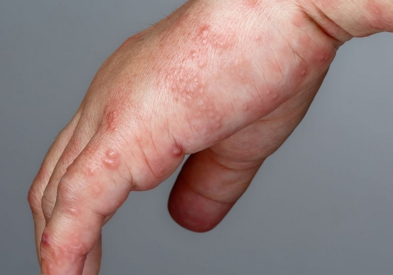 Top 10 Homeopathic Remedies for Scabies
